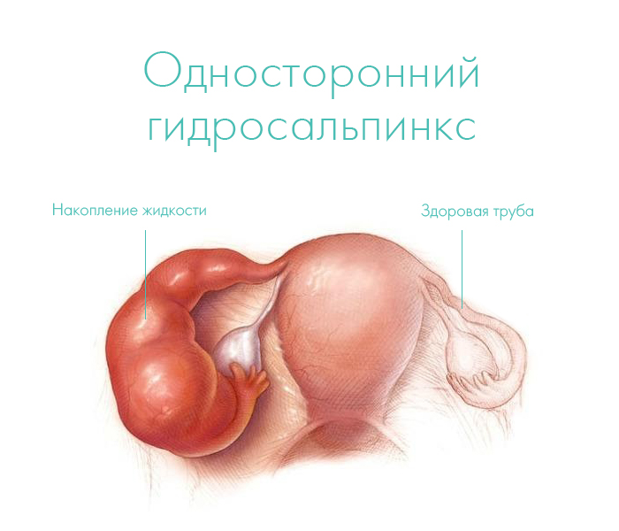 Що таке гідросаліпінкс і як впливає на фертильність?