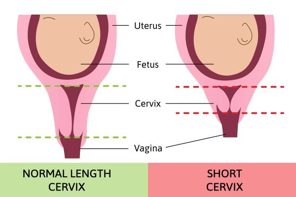 short cervix