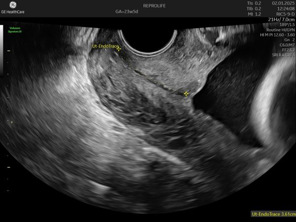 short cervix
