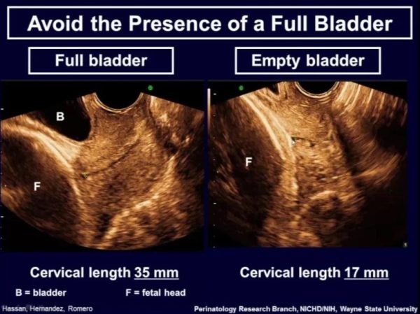 short cervix