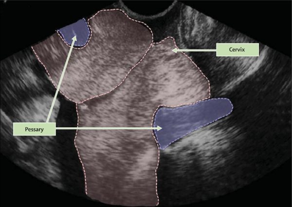 short cervix