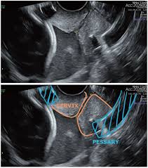 short cervix