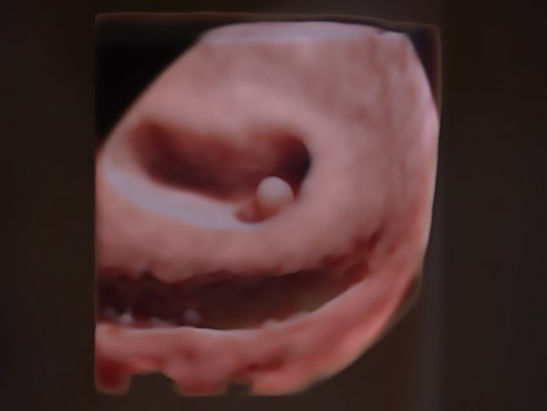 Одноплідна вагітність у 3D. Перше УЗД після ембріотрансферу.